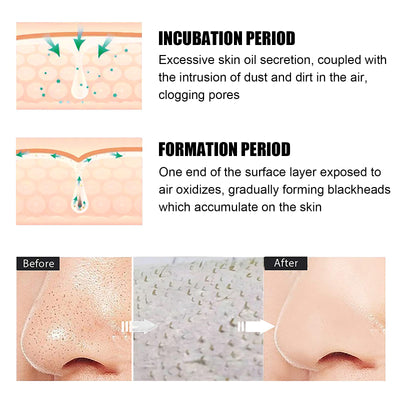 Blackhead Remover Tools - 15g Blackhead Creamwith 40Pcs Blackhead Pore Strips - 5 - CJ