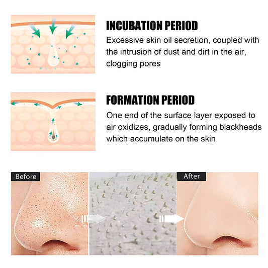 Blackhead Remover Tools - 15g Blackhead Creamwith 40Pcs Blackhead Pore Strips - 5 - CJ