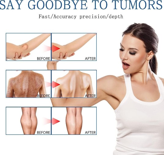 South Moon - Lipoma Removal Spray - 5 - CJ
