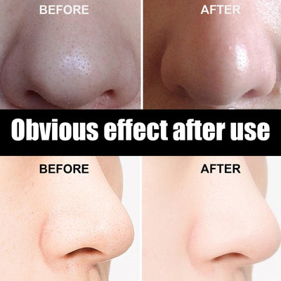 10 Pcs Blackhead Nose Patch Nose Pore Cleansing Strips Deep Cleansing Blackhead Remover Strips For Women Men - 5 - CJ
