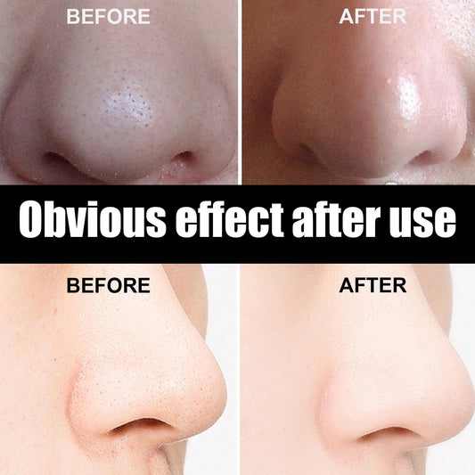 10 Pcs Blackhead Nose Patch Nose Pore Cleansing Strips Deep Cleansing Blackhead Remover Strips For Women Men - 5 - CJ