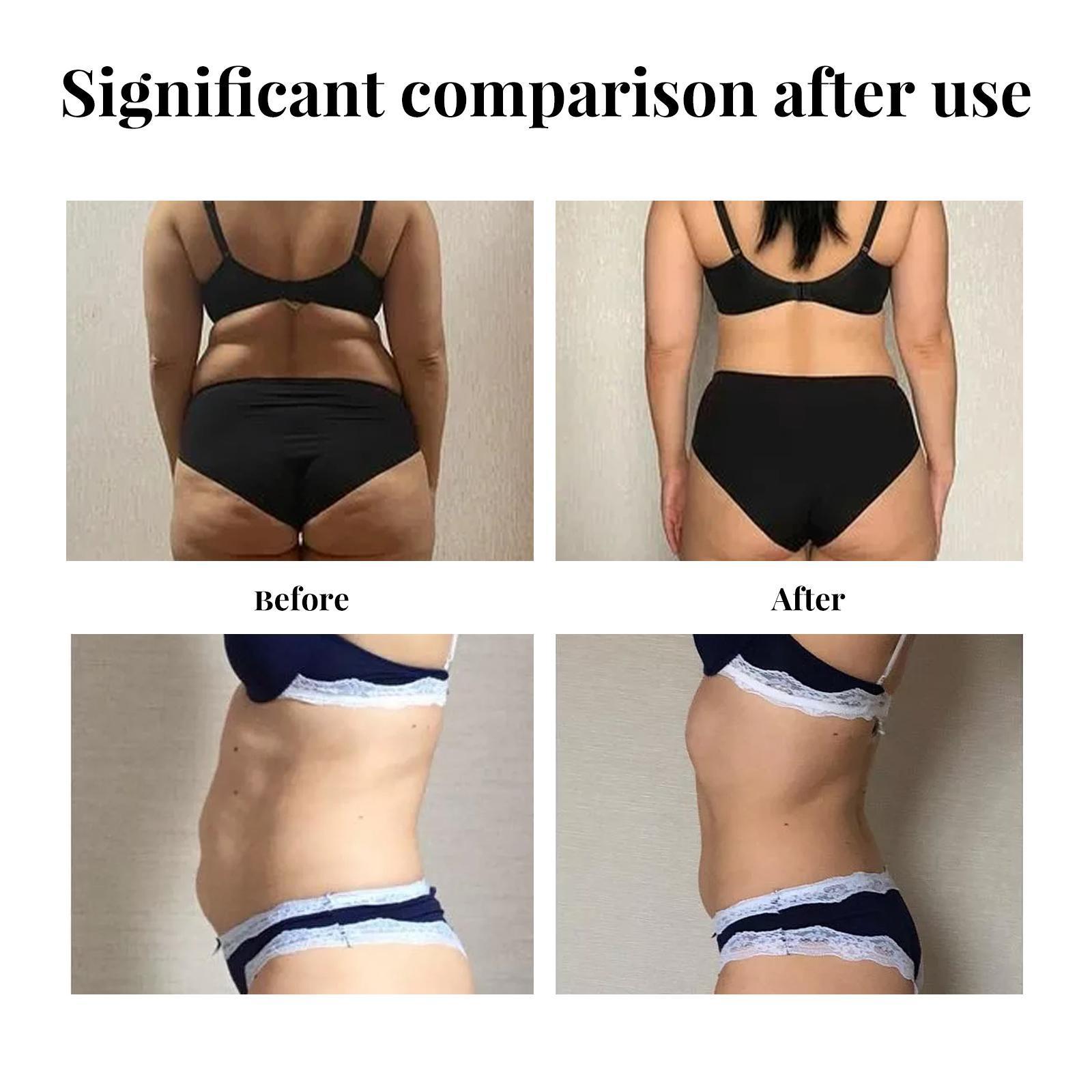 Yihe Abdomen Lifting Belt, Tightens Loose Skin And Reshapes Belly Button - 5 - CJ