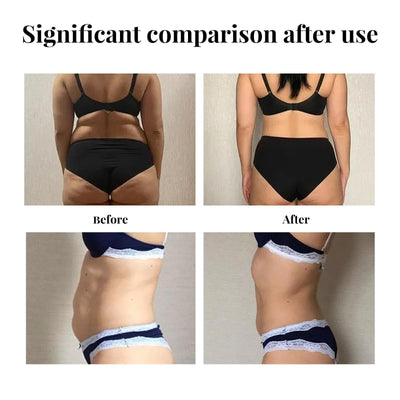 Yihe Abdomen Lifting Belt, Tightens Loose Skin And Reshapes Belly Button - 5 - CJ