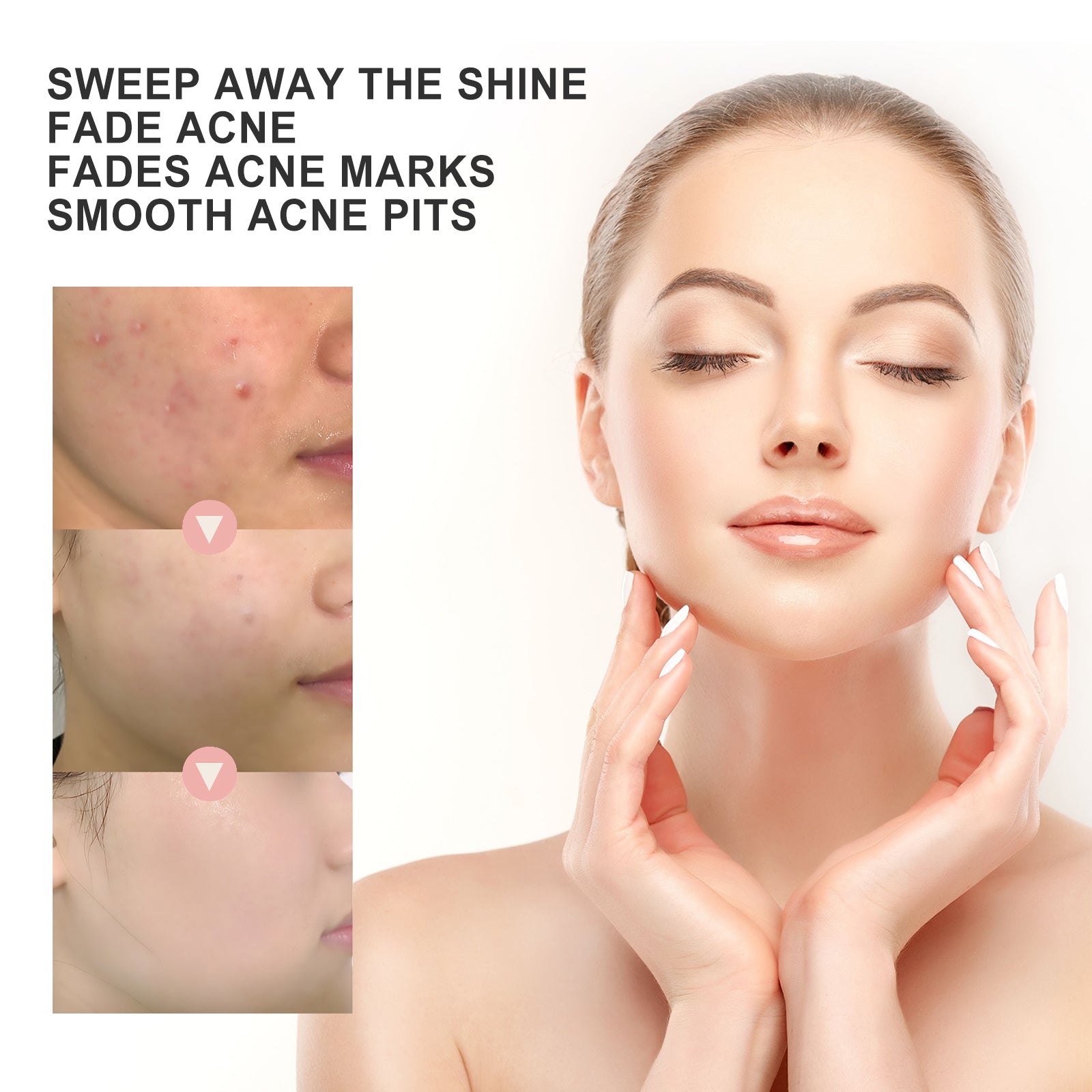 OUHOE Acne Patch Repair Acne Acne Redness Pore Cleansing & Moisturizing Patch - 5 - CJ