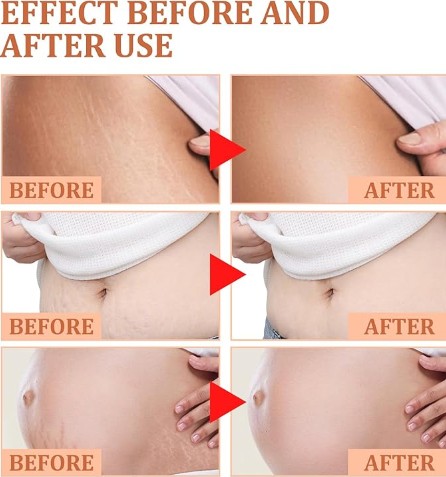 Eelhoe - Stretch Marks Removal Cream - 5 - CJ