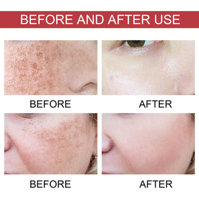 Hoygi Black Spot Repair Essence Lighten Skin Black Spot And Age Spot Moisturizing&Brightening Repair Essence - 5 - CJ
