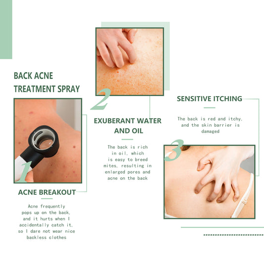 Jaysuing Back Acne Repair Spray, Repair Body Acne Fade Acne Mark Skin Care Spray - 5 - CJ