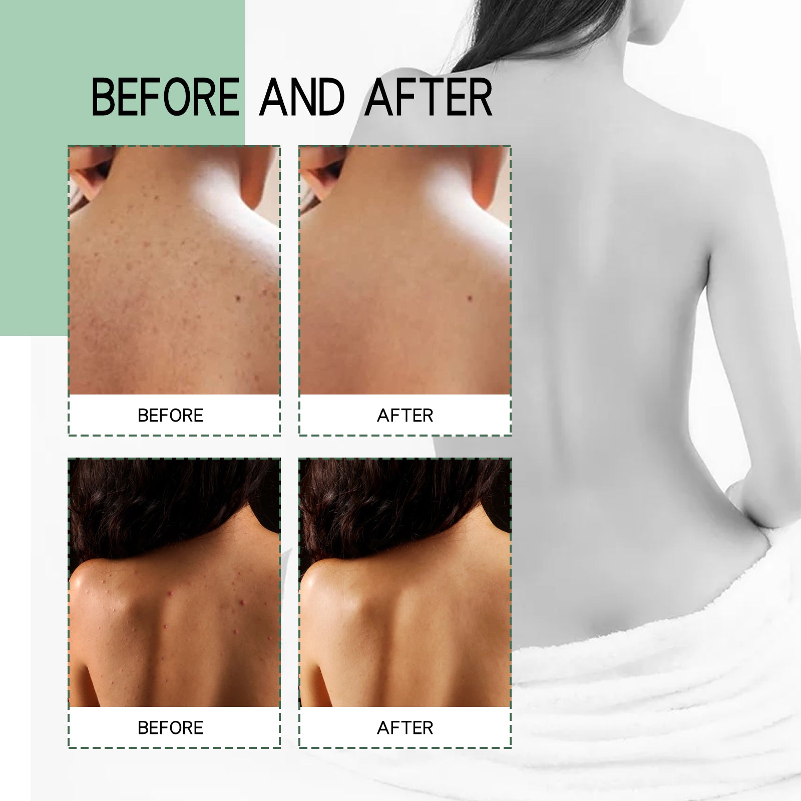 Jaysuing Back Acne Repair Spray, Repair Body Acne Fade Acne Mark Skin Care Spray - 5 - CJ